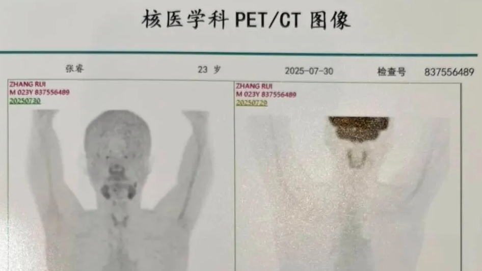23岁博士确诊胃癌晚期:常熬夜压力大热搜配图